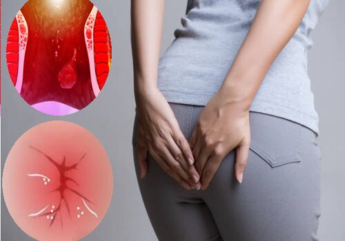 Nguyên nhân đau hậu môn và cách chữa đau hậu môn hiệu quả
