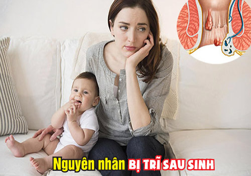 Bật mí nguyên nhân dẫn bị trĩ sau sinh và giải pháp khắc phục